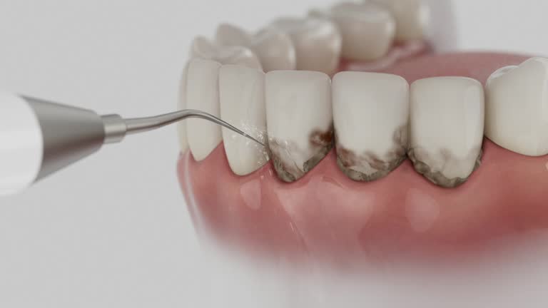 Trusted Dental Crowns And Bridges service in Slippery Rock University, PA - Dentist Open Now